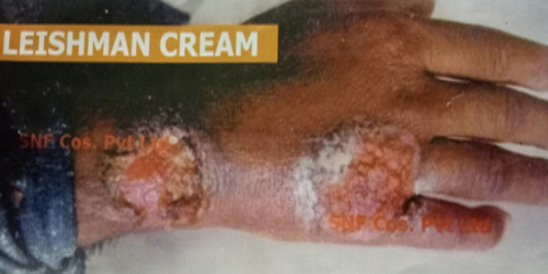 Leishmaniasis,Leishman Cream, SNF Cosmetics
