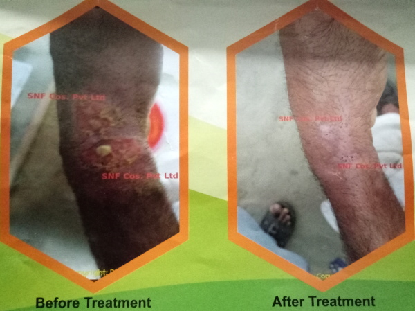 Leishmaniasis treatment kpk Pakistan leishman cream snf cosmetics